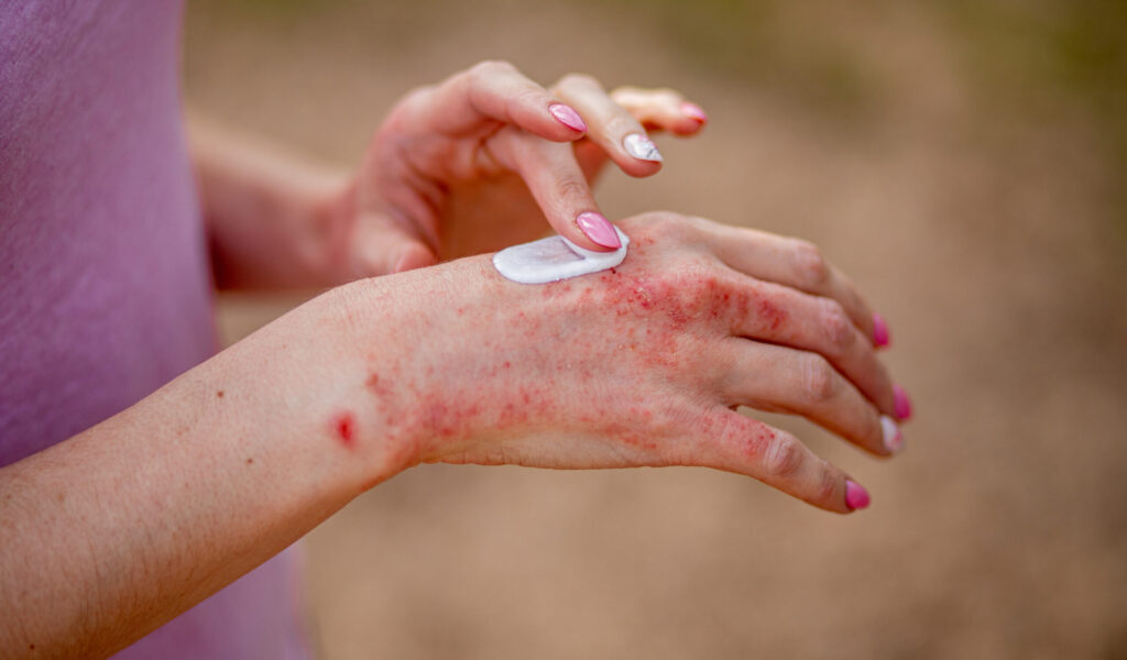 Eczema on the hands. The woman applying the ointment , creams in the treatment of eczema, psoriasis and other skin diseases. Skin problem concept.