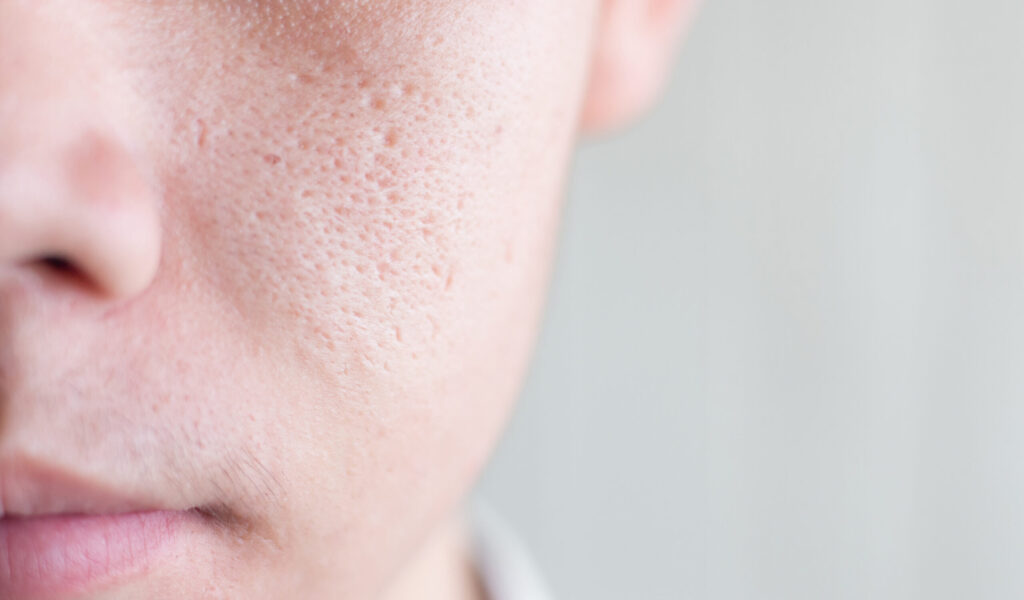 Close up image of half face Asia male with wide pores skin problem